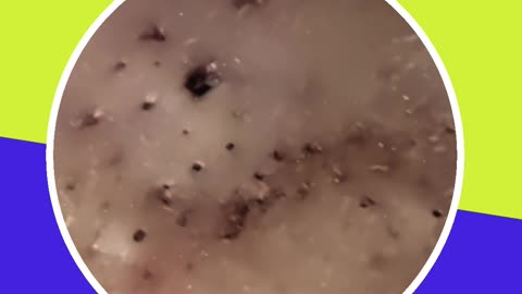 Blackhead removal new this week (ASMR) #8 #shorts