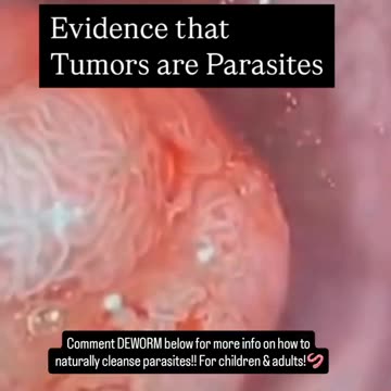 Tumours are your bodies natural defence against Parasites