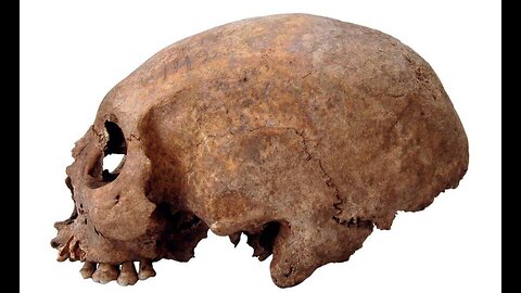 Elongated Skull Phenomenon: Global Presence, DNA Analysis, Blood Type Anomalies And More