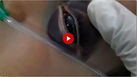 Do you know about panda eyes? This is how they are caused. Pure evil.
