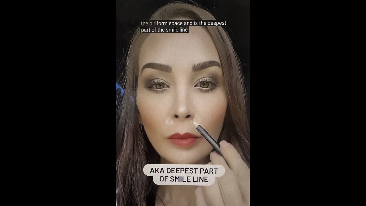 Piriform Fossa Filler Injection Technique Treatment Soon 💗💗💗