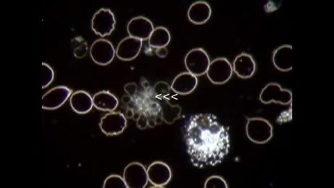 "Live Blood Analysis Using Dark Field Microscopy: A Focus on Cardio-Vascular Disease"