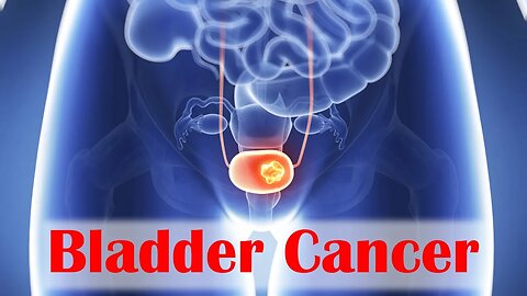 Bladder Cancer Solutions