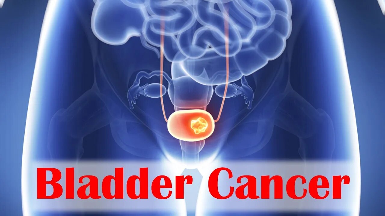 Bladder Cancer Solutions