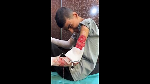 Tayseer Mansour Suffers Severe Burns in Israeli Strike – Faces Hand Amputation