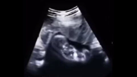 DYING PROOF ABORTION IS MURDER