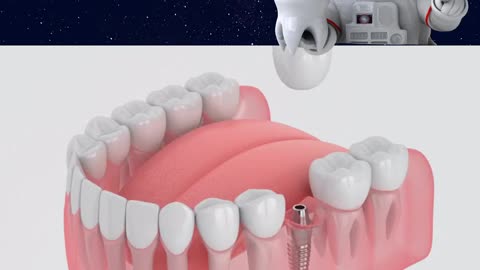 Dental Implants for a Confident Smile