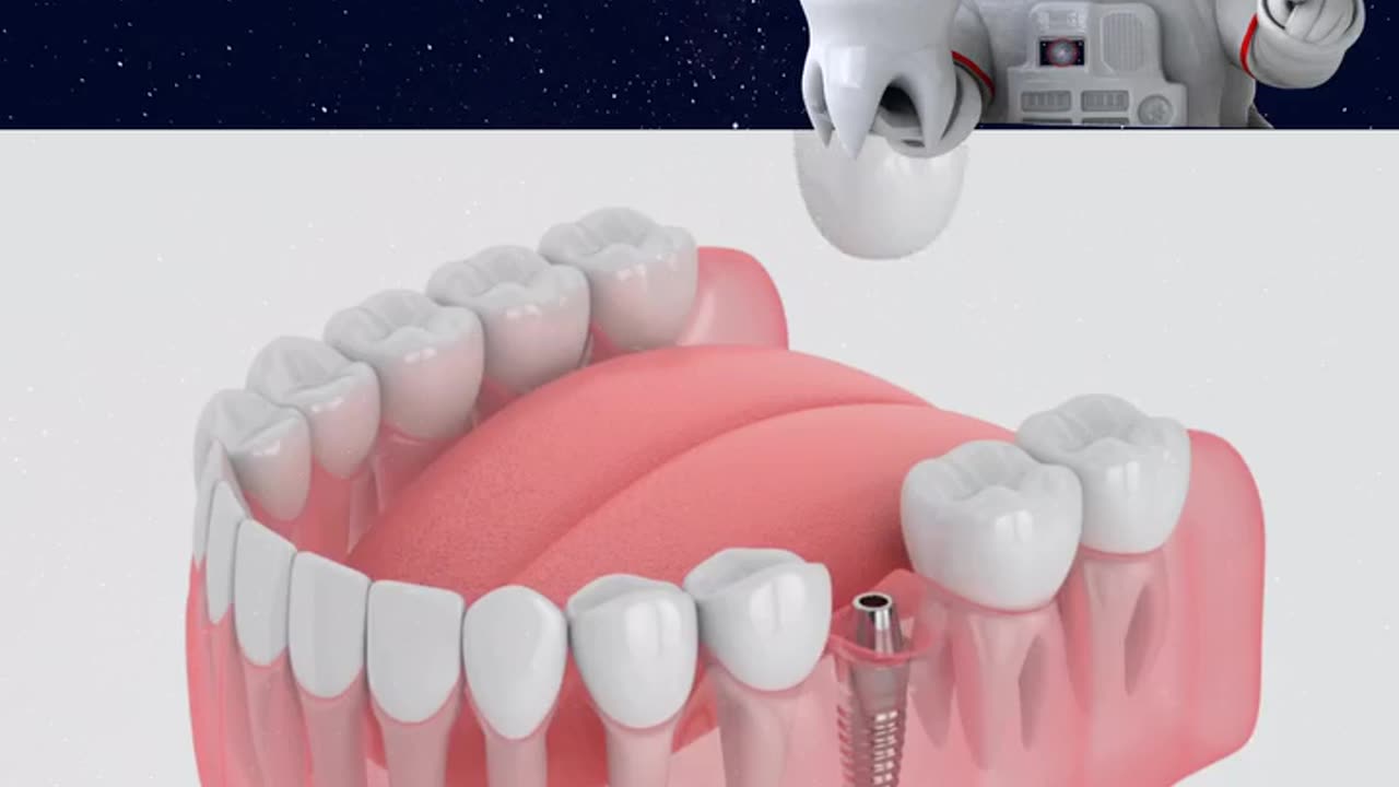 Dental Implants for a Confident Smile