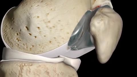 Patellofemoral Arthroplasty 3D Animation