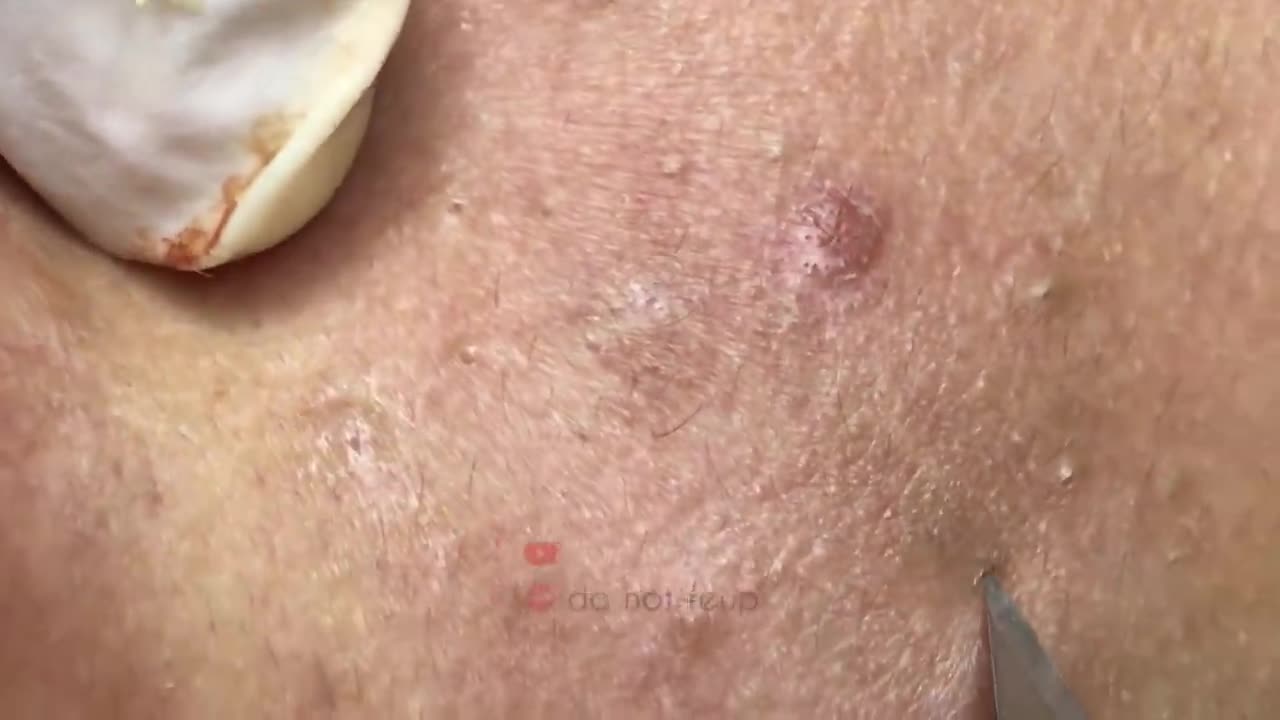 Blackheads Removal & Pimple Popper Cystic Acne Extraction #223