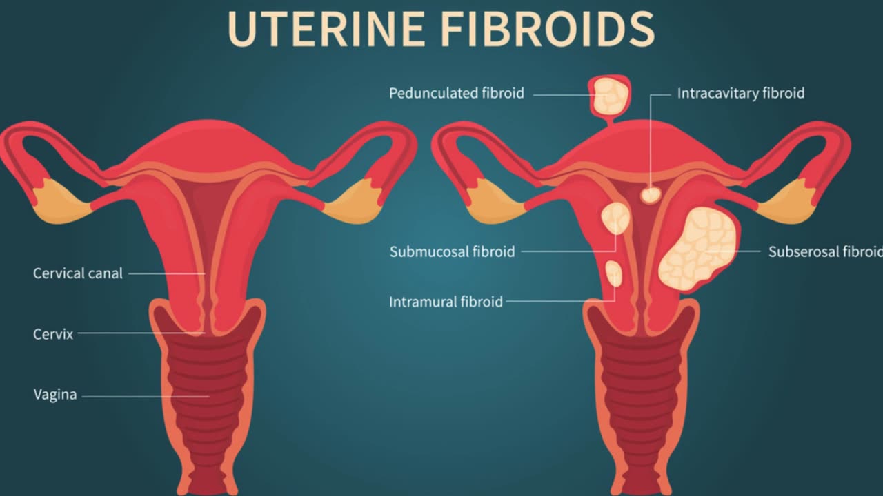 UTERINE FIBROIDS NUMBERS ARE GROWING - WHAT ARE FIBROIDS