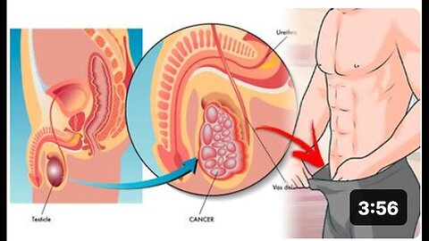 "7 Foods to Eat for Prostate Cancer Prevention"