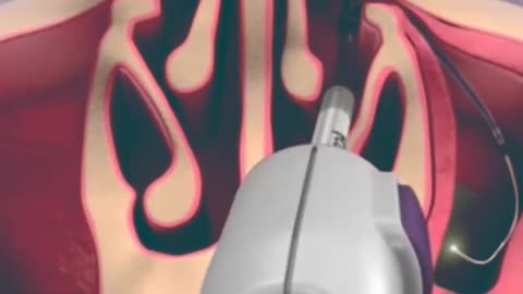 Balloon Sinuplasty Procedure 3D Animation