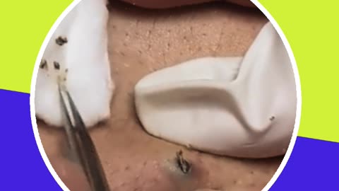 Blackhead removal new this week (ASMR) #15 #shorts