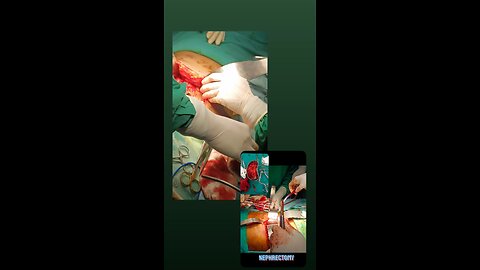 nephrectomy surgery