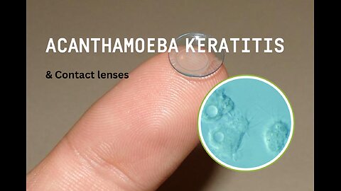 Acanthamoeba keratitis and contact lenses: A personal story