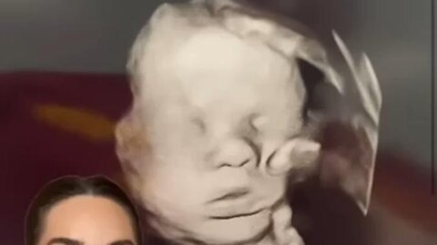 Hand of God Ultrasound