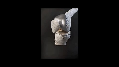 Total knee replacement #Bones#BoneHealth#BoneCare#StrongBones#BoneStrength#BoneHealing#BoneInjury