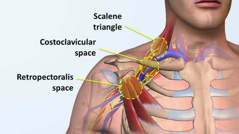 Arm DVTs in Athletes: Thoracic Outlet Syndrome