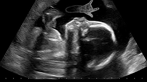 Advanced IVF & ICSI Treatments at Sumathi Hospital