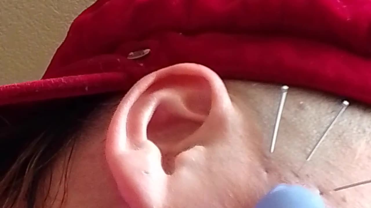 QUANTUM S1 E17 #dryneedling