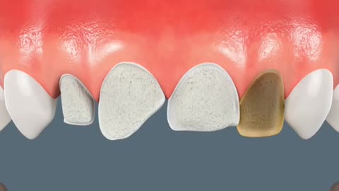 Dental Veneers Procedure 3D Animation (Porcelain Veneer)