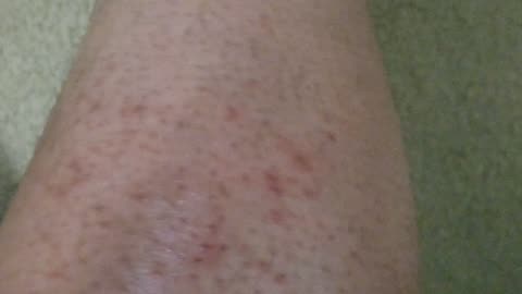 the evil aliens told the probation officers to put lice, fleas and scabies all over my room! part 3!