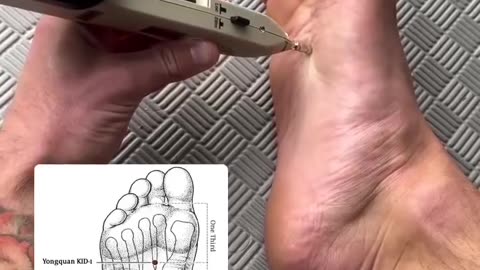 Acupuncture Points are DC Circuits!