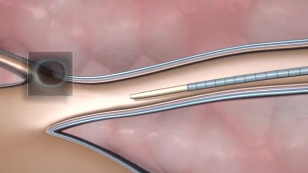 Varicose Vein Treatment 3D Animation ( Vein Blocking )