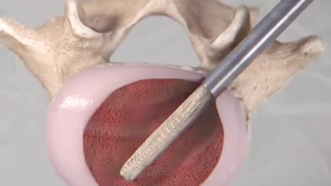 Expandable Interbody Fusion System 3D Animation (Spineology)