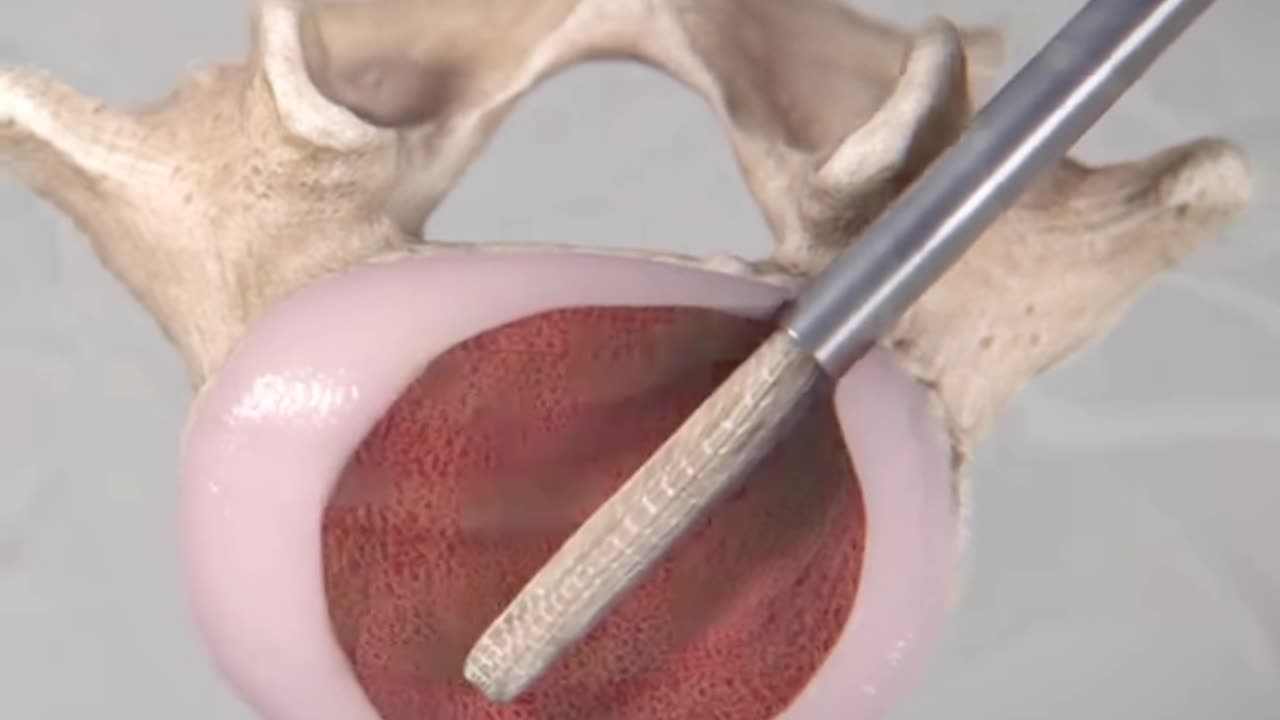 Expandable Interbody Fusion System 3D Animation (Spineology)