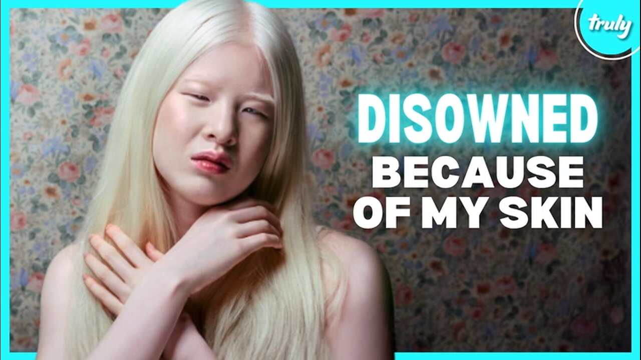 Albinism Isn’t ‘Bad Luck’ - It’s My Strength | BORN DIFFERENT