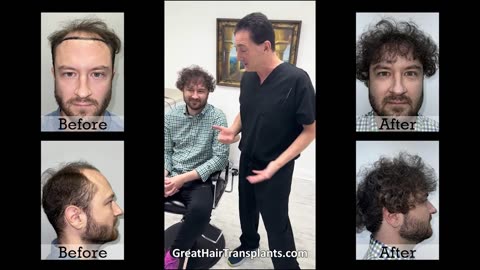 Dr. Brett Bolton Performs MaxHarvest™ Hair Transplant on Patient Mark