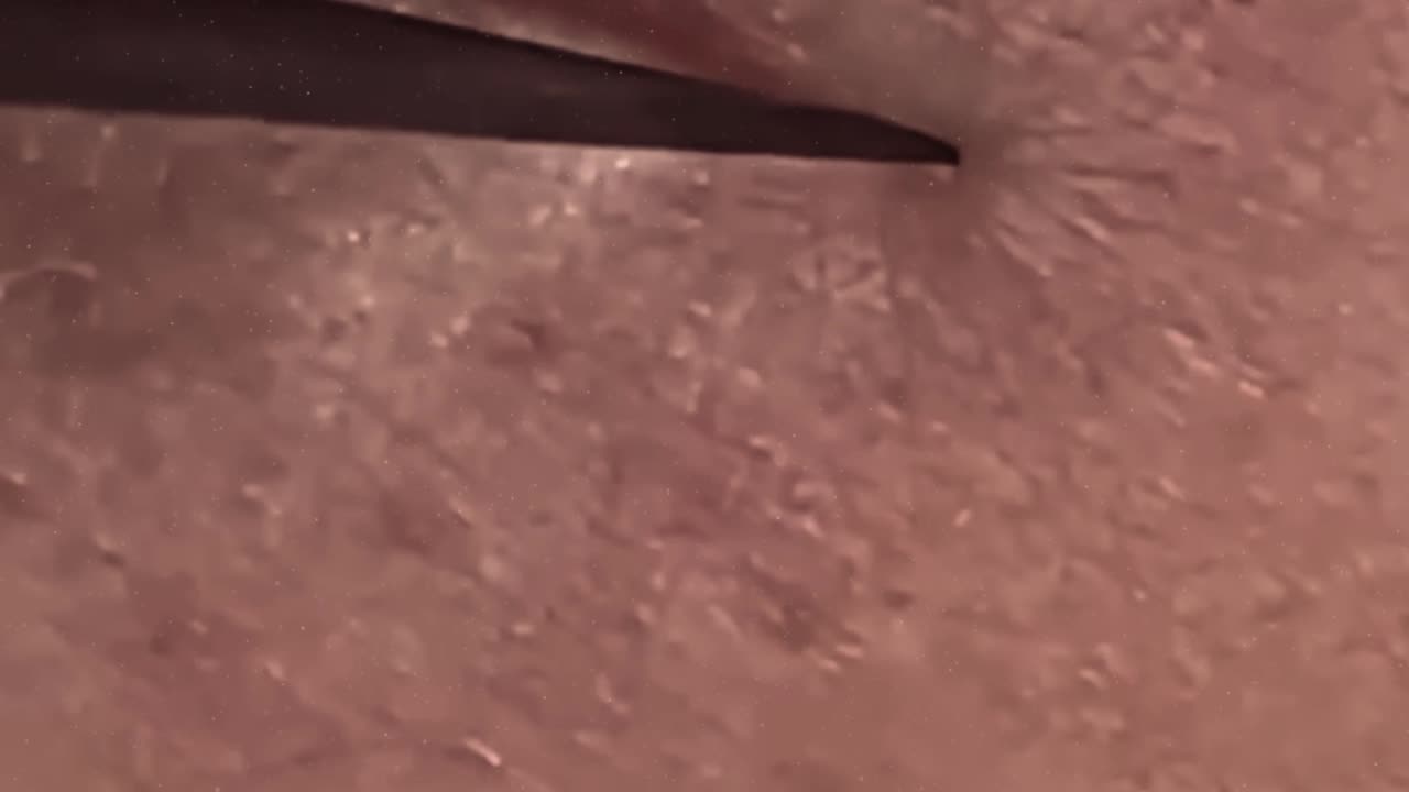 New satisfying blackhead removal (ASMR) #14