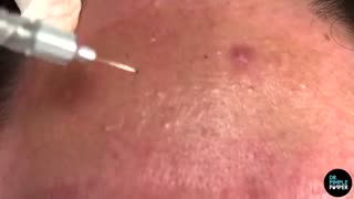 Comedones Galore on Face and Forehead Dr Pimple Popper Pops Removes Comedones