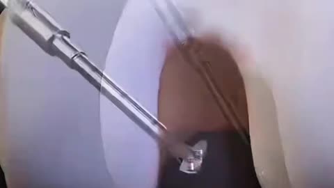 ACL Repair Surgery - Knee Ligament Reconstruction Explained.