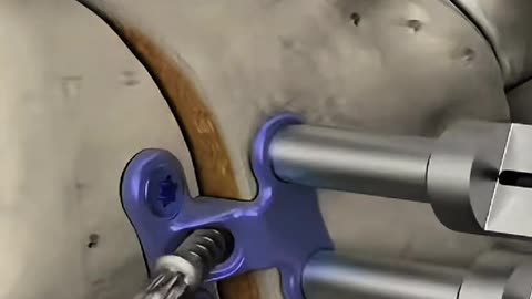 Flat Foot Surgery Explained, Walk Without Pain Again