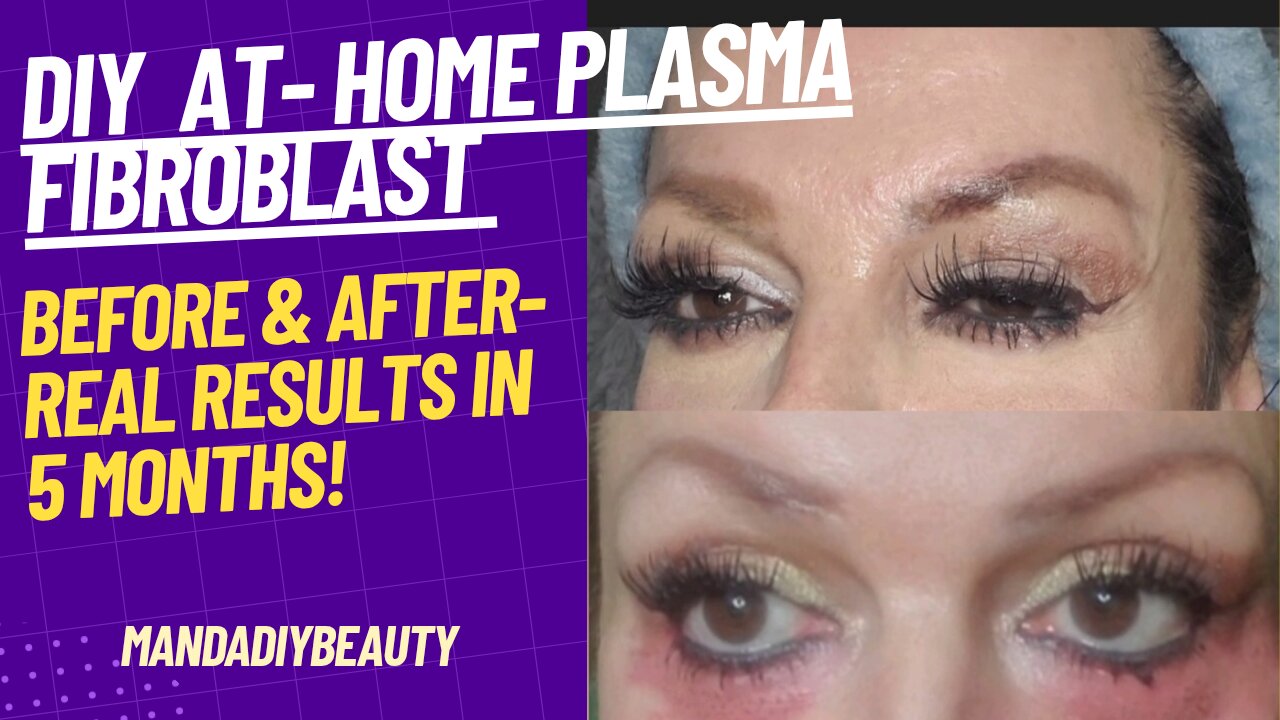 Upper Eyes Plasma Fibroblast Results- Before & Afters