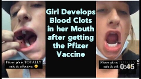 "Blood Clots Form in Girl's Mouth Post Pfizer Vaccine Administration"
