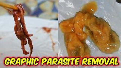 [Sep 7, 2022] WARNING DISGUSTING PARASITES REMOVED FROM TAKING TURPENTINE - VERY GRAPHIC [Sun Fruit Dan]