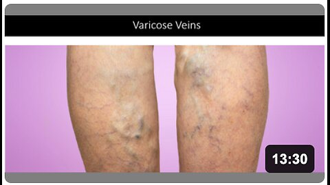 Varicose Veins - Natural Treatment