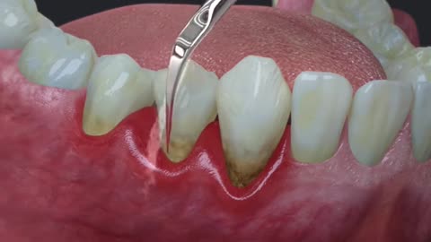 Basic Peridontal Treatment