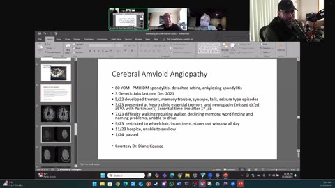(CLIP) High Amyloidogenicity in Post-Mortem 'Calamari' Clots, Cerebral Amyloid Angiopathy