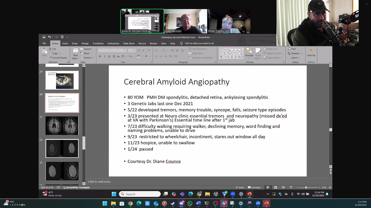(CLIP) High Amyloidogenicity in Post-Mortem 'Calamari' Clots, Cerebral Amyloid Angiopathy