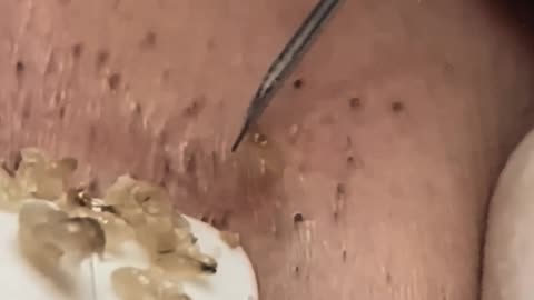 New satisfying blackhead removal #8