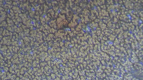 Bloody Zit Under a Microscope