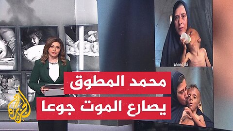 غابت ملامح الطفولة في غزة.. محمد المطوق لم يتجاوز العامين ويصارع الموت جوعا