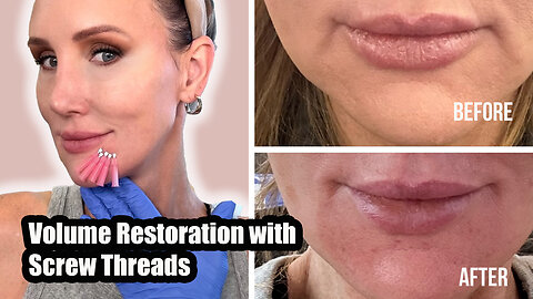 Volume Restoration with Screw Threads - Acecosm.com discount code STACY10