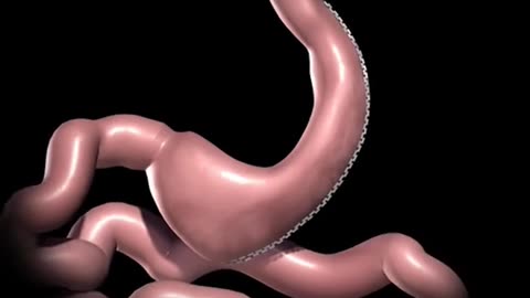 Sleeve Gastrectomy Surgery 3D Animation