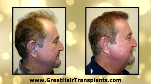 Watch This Fun Before & After Transformation Montage by Dr. Brett Bolton